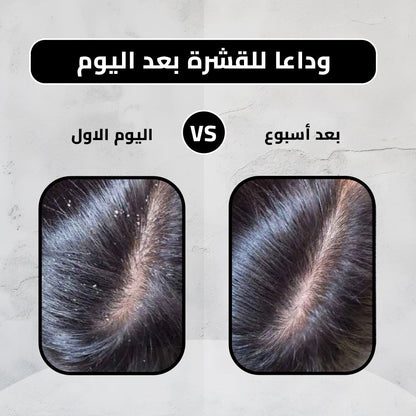 Lotion Concentrée Antipelliculaire - 150ml